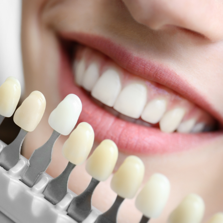 Clareamento dental em Joinville