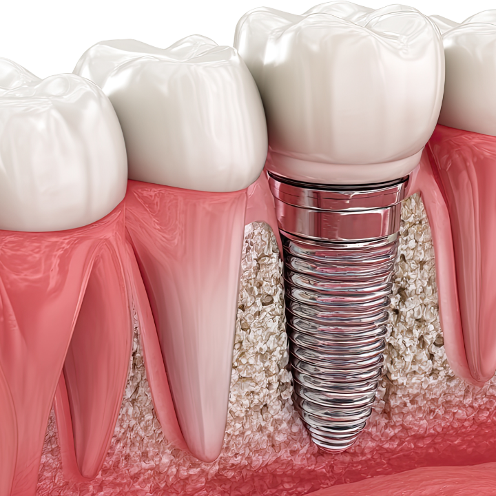 Implante dentário em Joinville